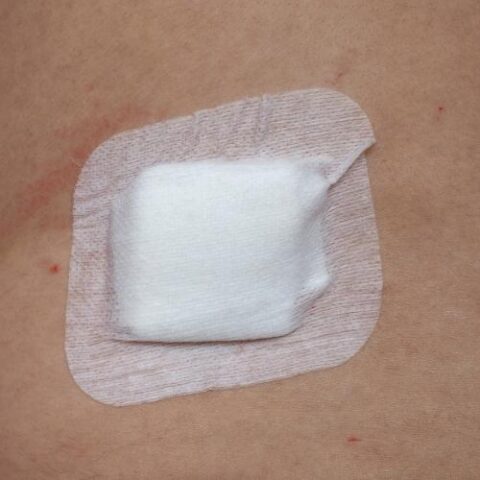 Nurse offering alginate dressing at home service for a recovering patient.